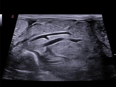 Pes neoplazija s trapezoidnim prikazom TPV